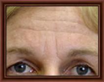 Botulinum toxin Before